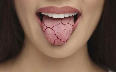 Mouth Breathing Dries the Mouth and Increases Cavities and Gum Disease