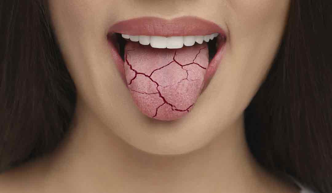 True Balance Dental dry mouth